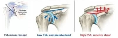 Illustrations of critical shoulder angle measurement, compressive load with a low CSA and superior shear with a high CSA